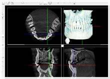 歯科用ＣＴ